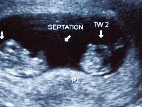 Multiple births Multiple births